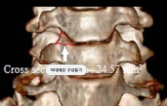 김영욱 교수, 검사 어려운 ‘경추협착증’…新진단법 등장