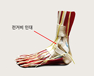 발목 자주 접질리면 ‘만성 발목 불안정증’으로 악화