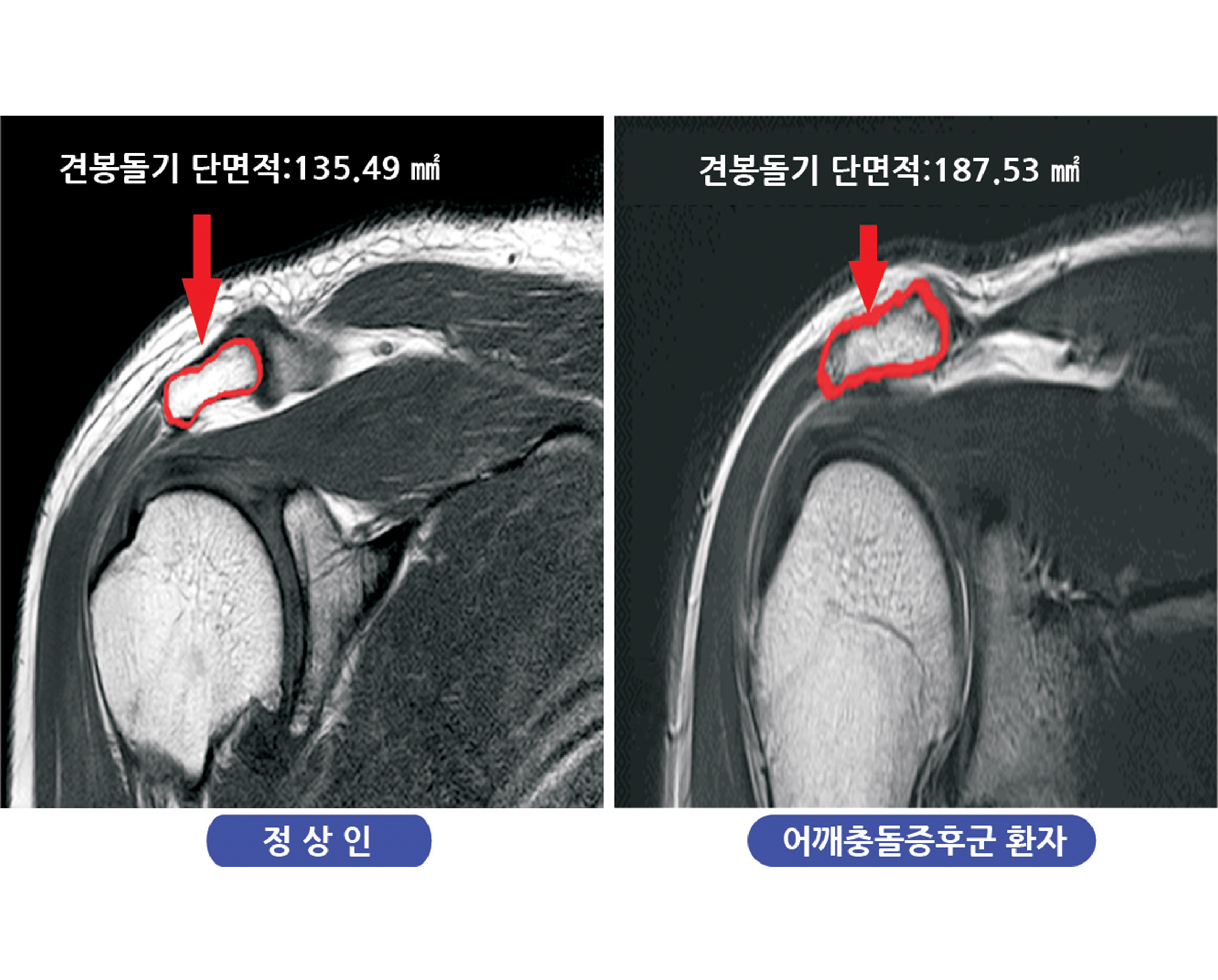 마취통증의학과 김영욱 교수, 어깨충돌증후군 새 진단법 개발