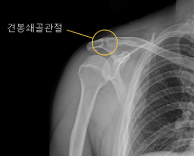국제성모병원 김영욱 교수, 관절 단면적 이용 견봉쇄골 관절염 진단법 개발