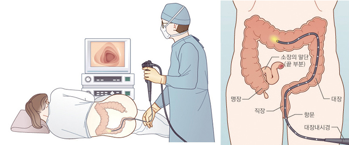 대장내시경