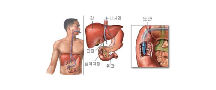 역행성내시경적 췌∙담도조영술 검사
