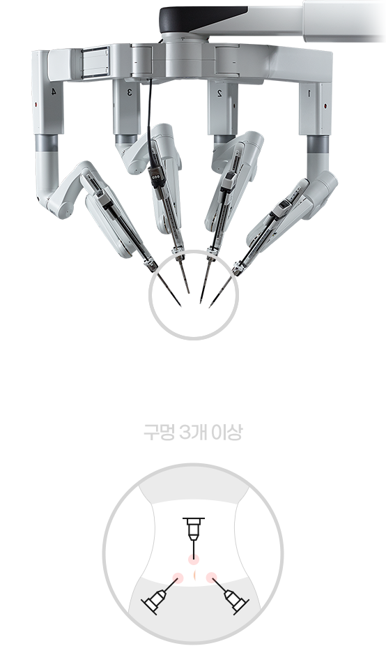일반 로봇수술