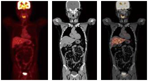 PET-CT 검사