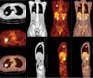 PET-CT